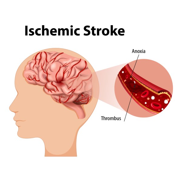 Ischemic stroke
